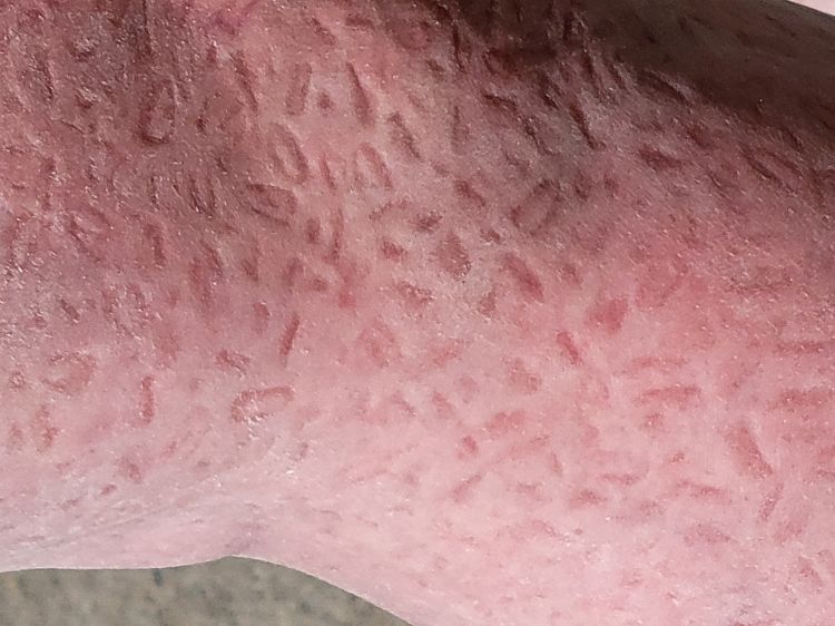 indents of grain on human skin